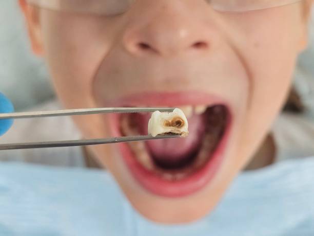 Best Emergency Treatment for Dental Infections or Abscesses in Little Round Lake, WI